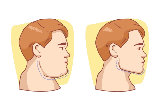 Double Chin Reduction in hyderabad