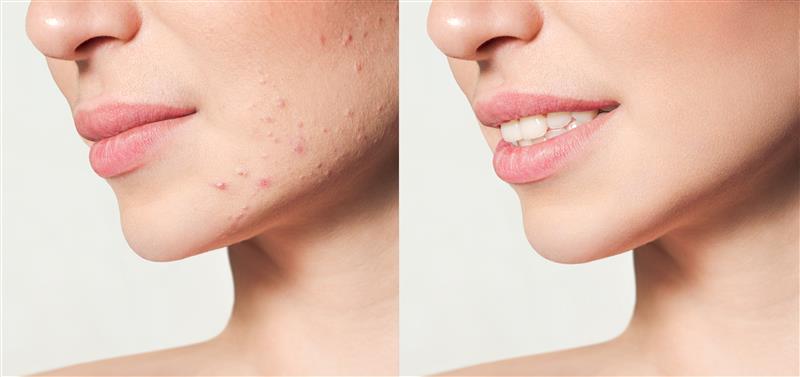 Best Acne Scar Treatment in Hyderabad and Hanamkonda
