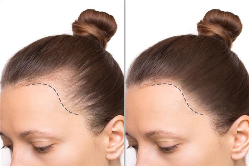 Hair Transplantation for Hairline Enhancement
