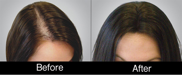 Before and after results of female hair loss treatment for PRP Treatment for Hair Regrowth